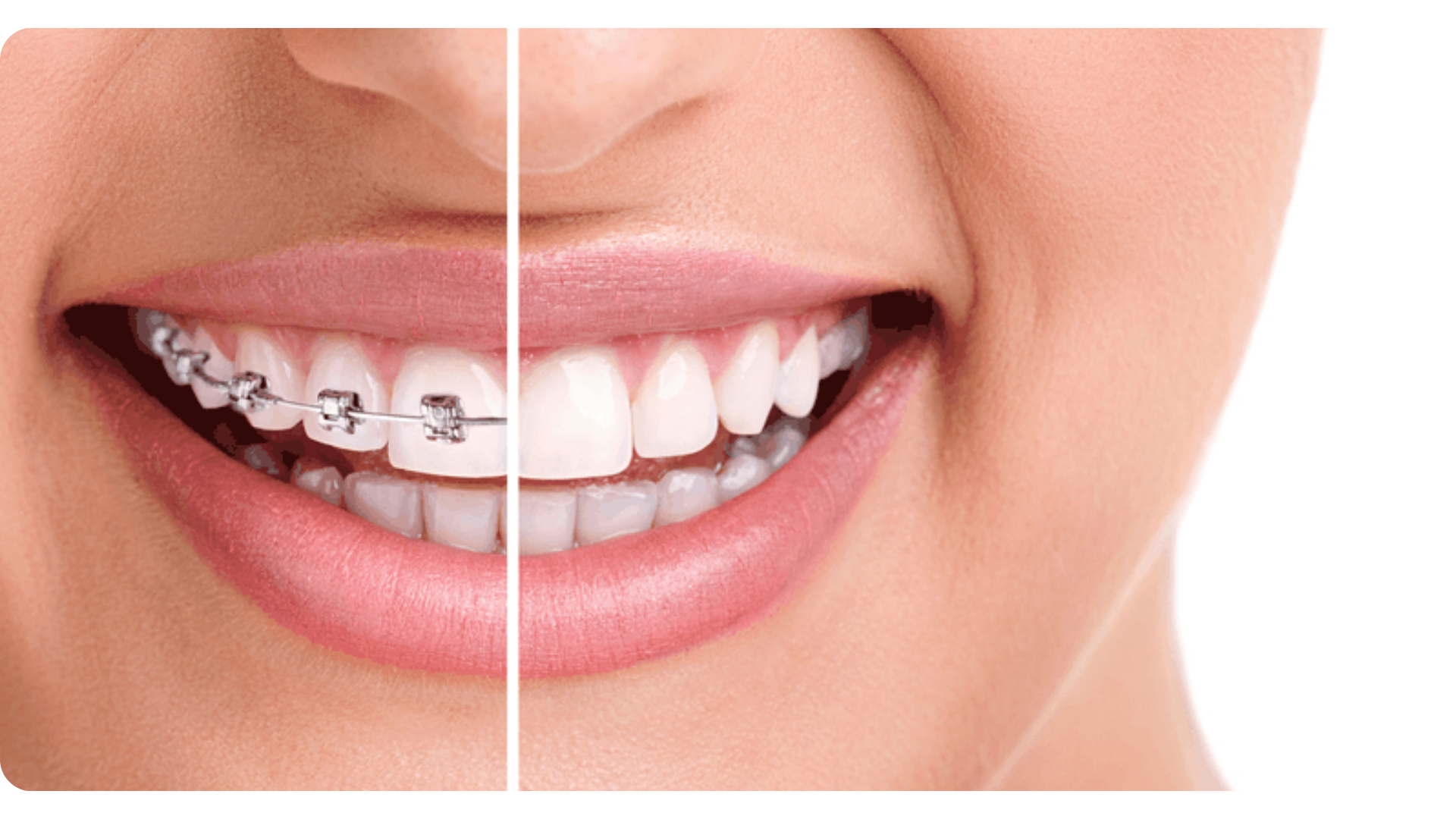 Braces & Aligners , Elevate Dental Wellness , Midhilapuri VUDA Colony , PM Palem , Visakhapatnam