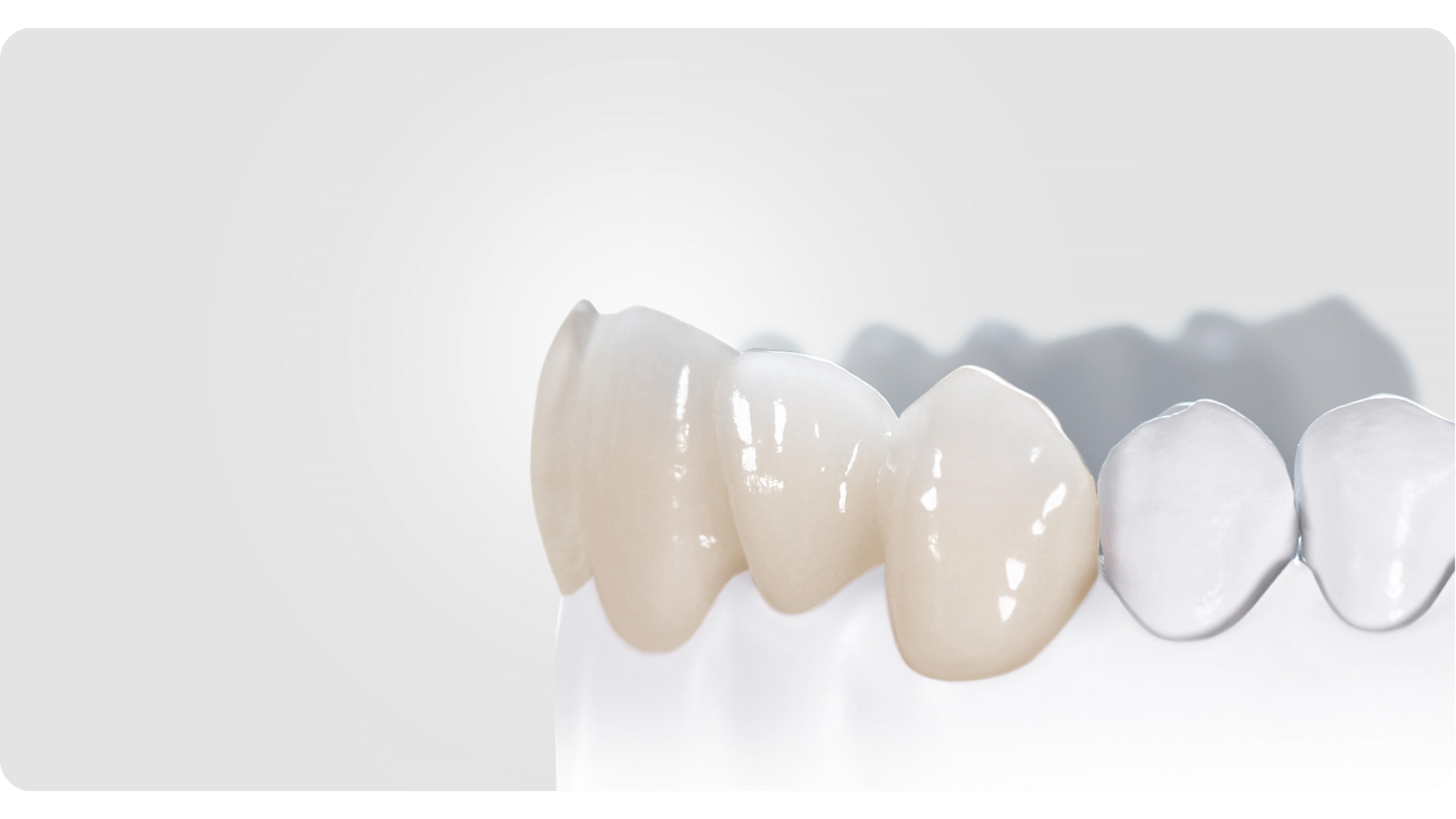 Crowns , Elevate Dental Wellness , Midhilapuri VUDA Colony , PM Palem , Visakhapatnam