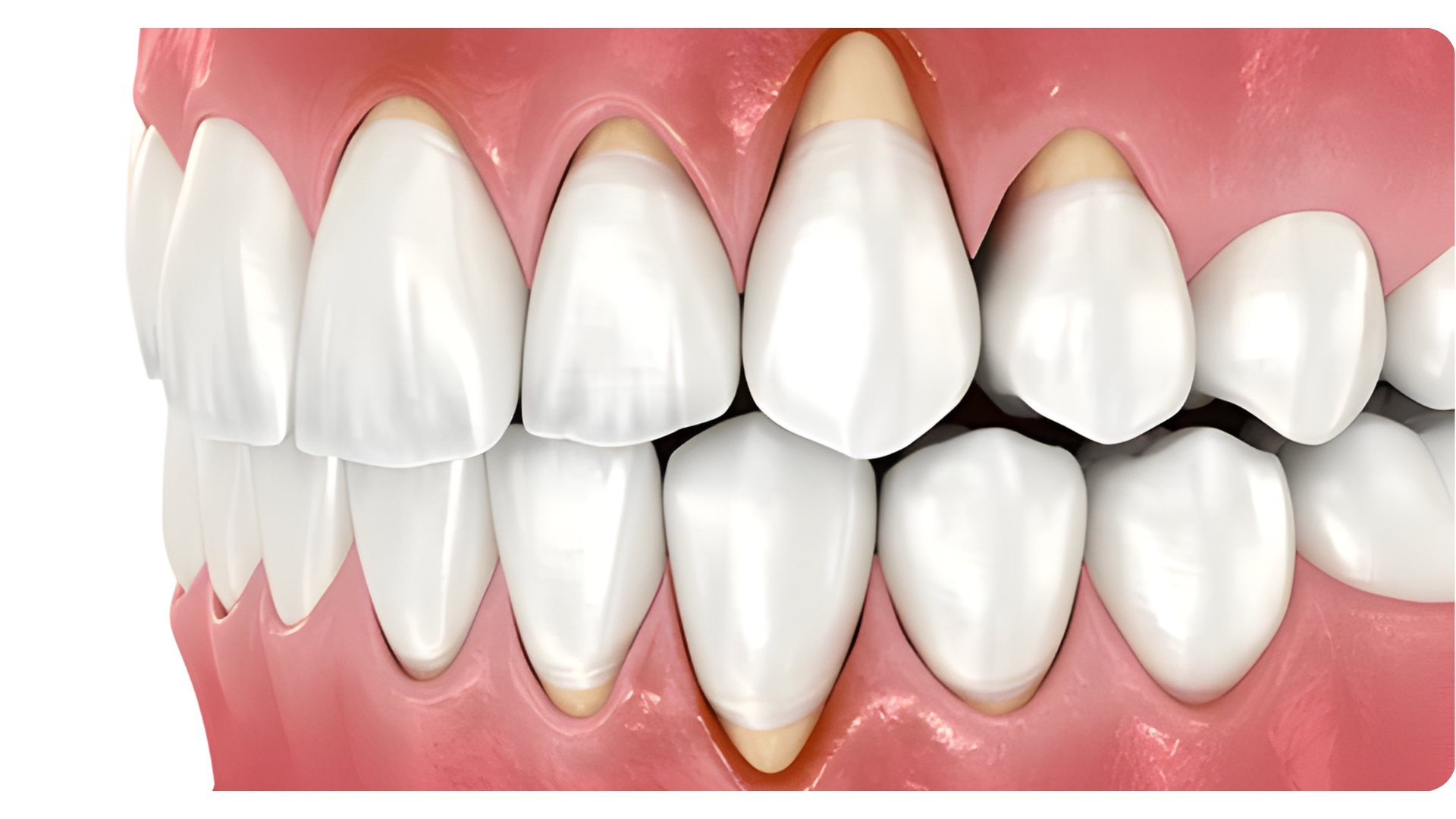 Gum care & Surgery , Elevate Dental Wellness , Midhilapuri VUDA Colony , PM Palem , Visakhapatnam