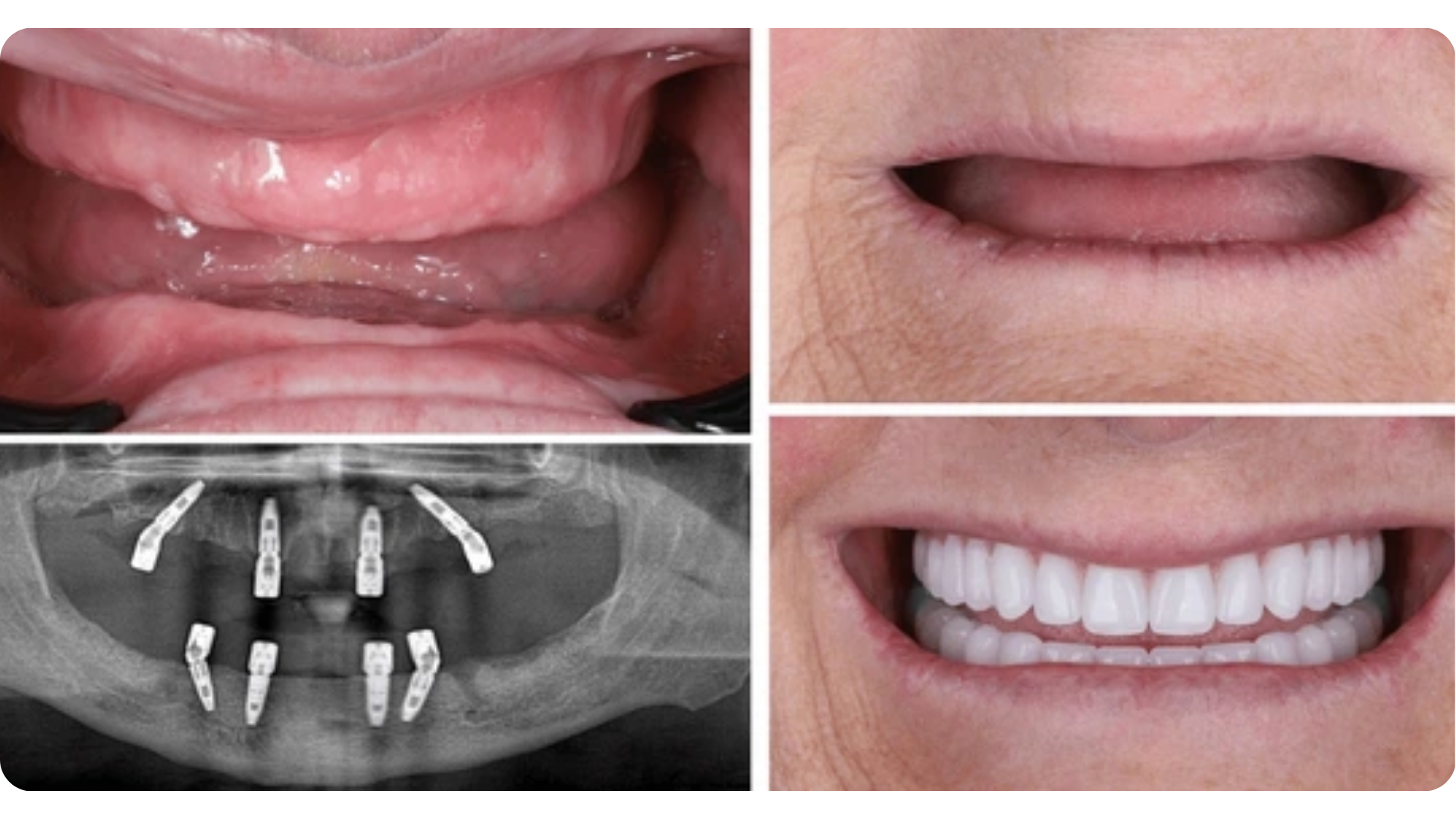 Implants , Elevate Dental Wellness , Midhilapuri VUDA Colony , PM Palem , Visakhapatnam