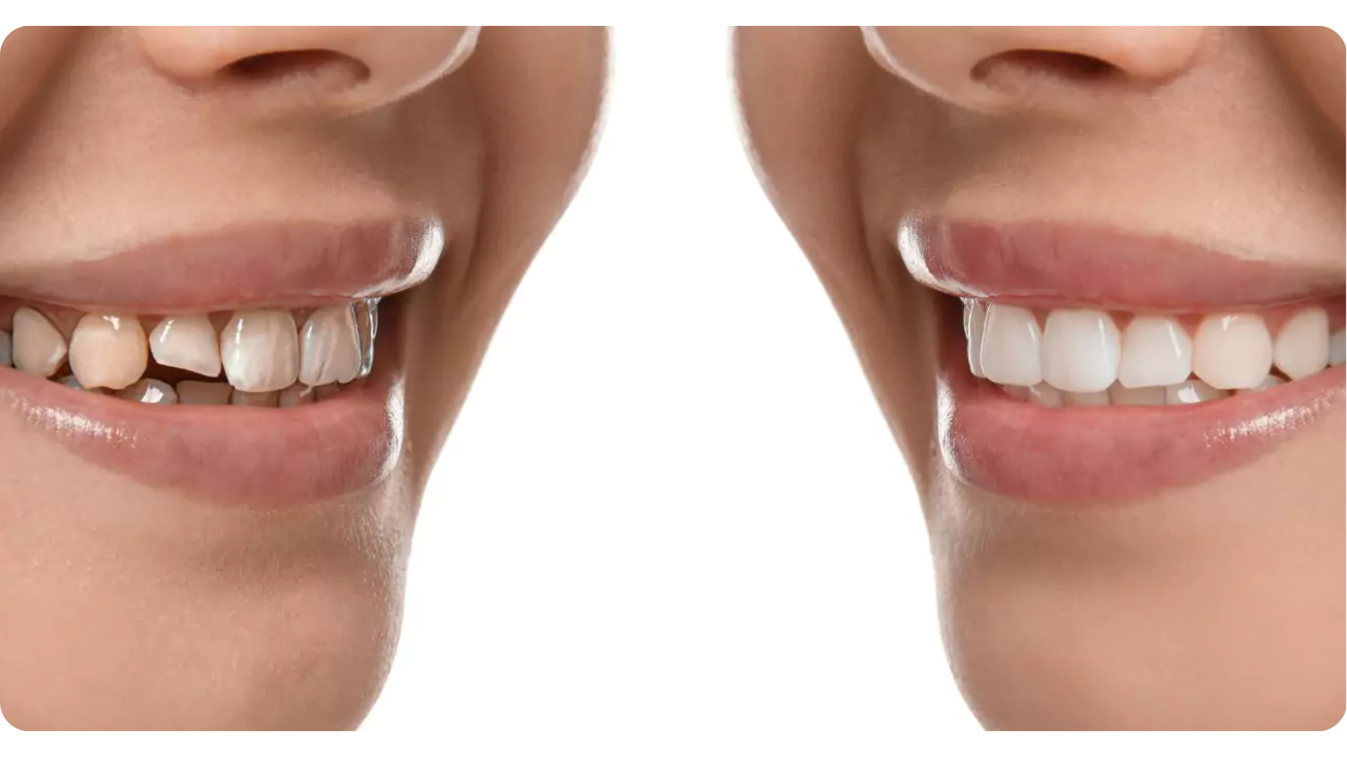Teeth Whitening , Elevate Dental Wellness , Midhilapuri VUDA Colony , PM Palem , Visakhapatnam